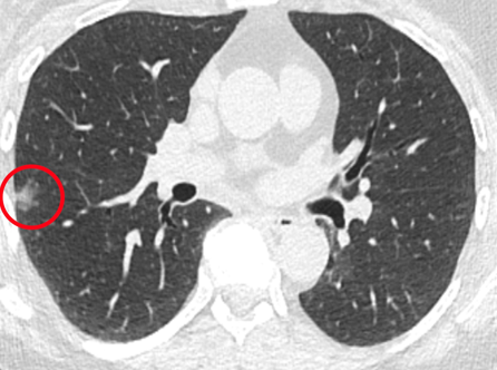 A scan of a lung with a lung nodule circled in red